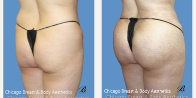 35-44 year old woman treated with Brazilian Butt Lift - 35-44 year old woman treated with Brazilian Butt Lift