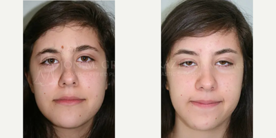 Woman treated with Mole Removal - Woman treated with Mole Removal