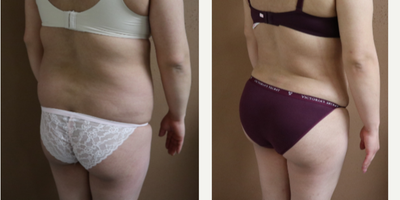 25-34 year old woman treated with Brazilian Butt Lift - Liposuction of abdomen, flanks, lower back and fat transfer to the buttocks (875 cc to eachbuttock).