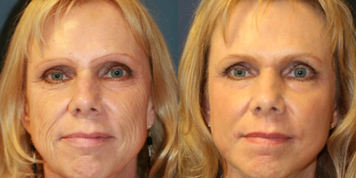 55-64 year old woman treated with Skin Rejuvenation - Before and two months after neck and lower face lift with liposuction of jowls and carbon dioxide laser treatment of skin around lips.  Steve Laverson, MD, Plastic Surgeon