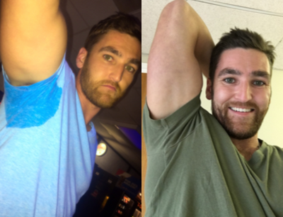 25-34 year old man treated with miraDry - miraDry in Connecticut for permanent underarm sweating treatment