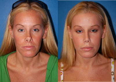 Revision Rhinoplasty - The patient underwent a revision rhinoplasty for correction of an upturned, unnatural appearing nose. The patient also had facial fat grafting underneath her eyes.