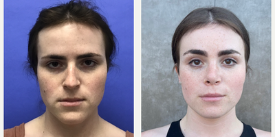 Patient woman treated with Voluma - 2 cc to Medial Cheeks - 25 to 34 year-old female patient is 3 months post-op from Facial Feminization surgery. Her procedures included: Forehead Lift, Hairline Lowering, Orbital Bony Contouring, Septorhinoplasty (open) with Cartilage Grafts and Weirs, Cheek Implants (small combined), Voluma - 2 cc to Medial Cheeks, Chin Reduction and Contour, Thyroid Cartilage Shave, Intranasal Lip Lift with Fat Augmentation, Soft Tissue to Nasolabial Folds and 300 Micrografts to the Fronto Temporal Recessions.