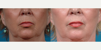 65-74 year old woman treated with Laser Resurfacing, CO2 Laser, Halo Laser, ProFractional Laser, YAG Laser - Before and after fully ablative perioral laser resurfacing