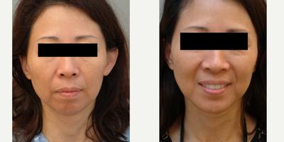 45-54 year old woman treated with Chin Surgery - Chin implant in office under sedation.