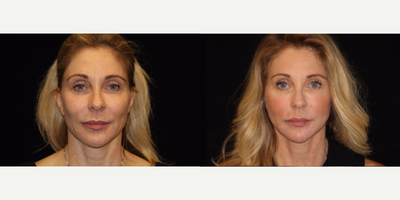 45-54 year old woman treated with Non Surgical Face Lift - This patient has done a lot over the years to help keep her skin looking young and bright. She wanted to do something bigger to help give her skin a nice boost but did not want to undergo surgery. In the office she did FaceTite or RFAL a radio frequency treatment that tightens the skin from the subdermal area to the skin surface. This treatment was also followed by Fractora a radio frequency treatment delivered through micro needles that give the skin a nice resurfacing and further tightening. These photos were taken 3 weeks after her treatment; the results will continue to improve over the next few months.