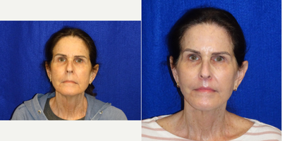65-74 year old woman treated with Facelift, Neck Lift, Lip Surgery - Lower face lift and neck lift with upper lip shortening