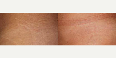 Woman treated with ResurFX - Photo provided courtesy of Lumenis, Ltd., performed by Matteo Tretti Clementoni, MD