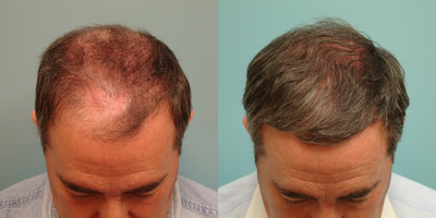 49 year old man treated with minoxidil + LLLT - This gentleman was unable to proceed with a HT at the time, and wanted to try non-surgical treatment first; he did not wish to take Propecia/finasteride.