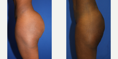 35-44 year old woman treated with Silicone Injection Removal - Meet a 42-year-old black female patient who weighed 140 pounds and suffered from pain and skin deformity caused by raw silicone injections in her buttocks  . In January 2023, she traveled all the way from New Orleans, Louisiana to Beverly Hills, California to have the silicone removed (closed method) by renowned Dr. J. Timothy Katzen. After the procedure, her life drastically changed for the better as she no longer experiences any pain or deformity in her buttocks area. She is truly delighted with the outcome!