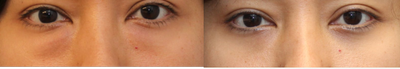Lower blepharoplasty for eye bags - Transconjunctival lower blepharoplasty was performed by Dr. Kotlus for prominent lower eyelid fat pads in a young woman.