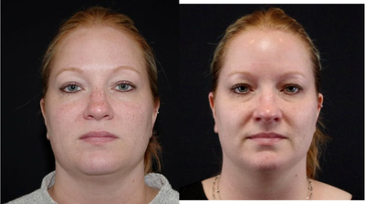 35-44 year old woman treated with IPL - 40 year old female received IPL treatment for red and brown spots; photos depict patient's results 5 months post-treatment.