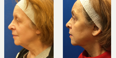 55-64 year old woman treated with Facelift - This would wanted to focus on her neck and jawline. We did a mini-facelift with neck extension. After the swelling resolved she is looking sharp! I recommended fat transfer to volumize at the time ( 80% of my facelift patients get this), but she wanted to wait.