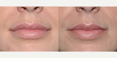 Lip Surgery to Correct Asymmetry from Vascular Malformations - This 23 year old woman had blood vessel malformations on both sides of her upper lip that resulted in asymmetry. The malformations were removed, and her upper lip reconstructed to create better symmetry of her upper lip. She is shown 9 months post-operative.