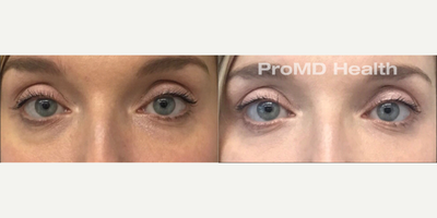 Woman treated with Sculptra, Hyaluronidase - Woman treated with Sculptra, Hyaluronidase
