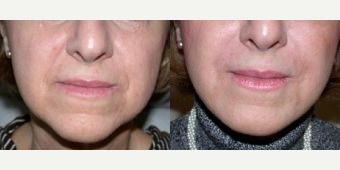 55-64 year old woman treated with Radiesse - Radiesse to nasolabial folds, jawline and oral commissures, 64 yrs