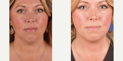 Woman treated with Kybella - Woman treated with Kybella