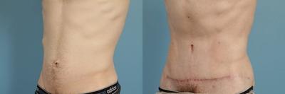 Man treated with Tummy Tuck - Man treated with Tummy Tuck