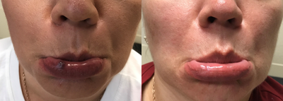 35-44 year old woman treated with Neo Laser - Venous lake removal with one treatment of Aerolase ND YAG laser.