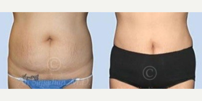 Woman treated with Mini Tummy Tuck - Mini Tummy Tuck