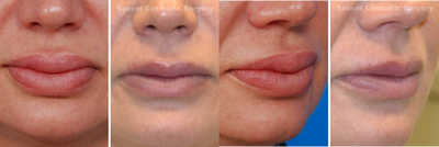 Lip Reduction and Repair - 
	Lip reduction performed on a patient with a foreign substance in her lip, which she didn't like due to its unnatural look. Dr. Svehlak removed the material and did a lip reduction to give her more natural-looking lips with a nice shape, which fit her face perfectly.
