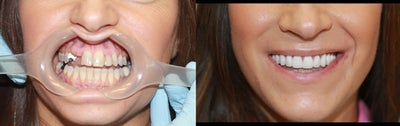 35 year old female treated with All-on-4 DentalImplant Procedure - 35 year old female treated with All-on-4 DentalImplant Procedure