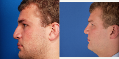 25-34 year old man treated with Cleft Lip And Palate Repair - This young man underwent a repair of his cleft lip and associated nasal deformity. He had a repair as a child but returned for improvement in adulthood.