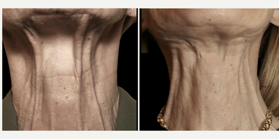 71 year old woman treated with MyEllevate, Nonsurgical Neck Lift, Neck Lift - 71 year old female who was complaining of the sagging appearance of her neck, prominent platysma muscle bands, and loss of definition of the jawline. The MyEllevate system was utilized to enhance the jawline appearance with a continuous permanent U-shaped suture support system that was placed with a specialized light-guided device through tiny skin punctures just below the mandible and then tightened to achieve the desired effect.The system also enabled a division of the visible platysma muscle bands on either side of the midline through similar puncture sites in the skin to enhance the neck contour. Finally, a limited skin tuck, known as MyEllevate Plus, was performed to further improve the appearance of the jowls and the neck.
