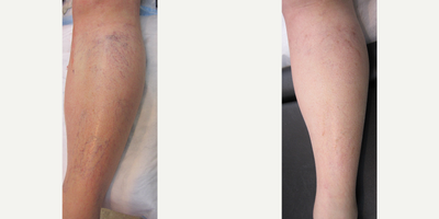 35-44 year old woman treated with Sclerotherapy - 3 sclerotherapy treatments