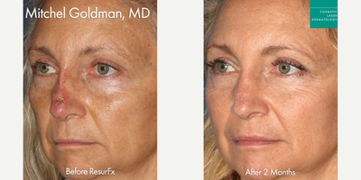 Woman treated with ResurFX - Woman treated with ResurFX