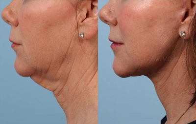 Woman treated with Vivace - Woman treated with Vivace