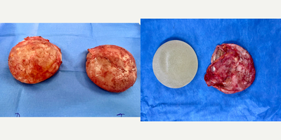 25-34 year old woman treated with Breast Implant Removal, Capsular Contracture Treatment - Female patient with breast illnes implant syndrome and severe capsular contracture. She had a breast augmentation with textured round silicon gel implants 4 years ago. She underwent to implant removal with Enbloc technique.