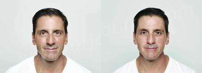 Man treated with Restylane - Man treated with 3.0 CC of Restylane to nasolabial folds and 50 units of Dysport to glabella