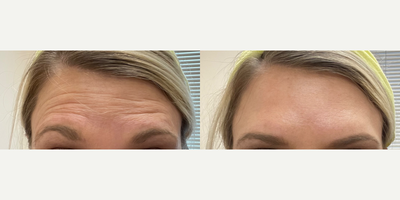 35-44 year old woman treated with Jeuveau - Neurotoxin into forehead for wrinkles