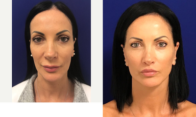 45-54 year old woman treated with Mini Lift - My 45 yo patient underwent a Minilift, Lip Lift & CO2 Laser Resurfacing 5 months ago. In her 5 months post op photo, You can also see the result of the injectable filler, Restylane Lyft to her jawline to make it more defined and compliment her facial features. She is extremely happy with her rejuvenated appearance.