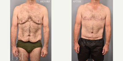 Chest Contouring Surgery with 2nd Stage Body Lift - This wonderful patient lost 120lbs after bariatric surgery and kept the weight off with lifestyle changes. he was bothered by excess skin on his chest, belly, sides and back. Despite, his consistent exercise routine, he couldn't get rid of the loose, extra skin.He underwent gynecomastia with free nipple grafts and a subsequent, second stage belt lipectomy (or body lift). These are his one year results from the original gynecomastia (chest) surgery.