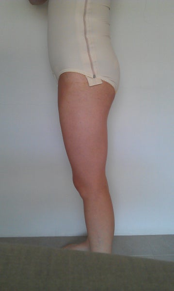 Wearing a Compression Garment after Abdominoplasty - Dr Jeremy Hunt