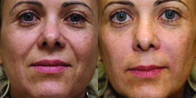 Juvederm - 2 Syringes of JUVDERM Ultra Plus XC Injected into Nasolabial Folds (smile lines).