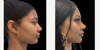 18-24 year old woman treated with Rhinoplasty - A rhinoplasty in an Afro-carribean nose displaying a wide nasal bridge, bulbous tip and wide nostrils. The nose is narrowed along its whole length. This included narrowing the nasal bridge, refining the nasal tip and performing a nostril reduction (alar reduction)On the side view  the tip refinement and slight increase in projection has improved the profile aesthetics