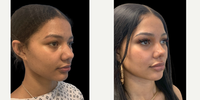 18-24 year old woman treated with Rhinoplasty - A rhinoplasty in an Afro-carribean nose displaying a wide nasal bridge, bulbous tip and wide nostrils. The nose is narrowed along its whole length. This included narrowing the nasal bridge, refining the nasal tip and performing a nostril reduction (alar reduction)On the side view  the tip refinement and slight increase in projection has improved the profile aesthetics