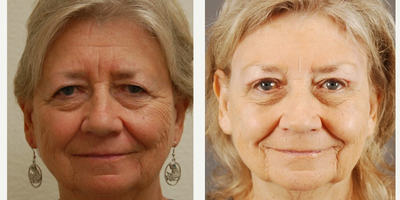 65-74 year old woman treated with Brow Lift - This woman underwent an upper eyelid blepharoplasty and brow lift.