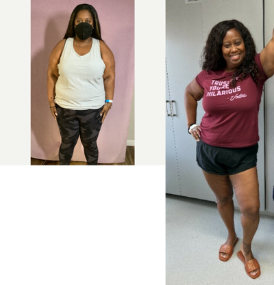 25-34 year old woman treated with Orbera Gastric Balloon - Our patient lost a total of 62 Lbs in 6 months after her Orbera Gastric Balloon procedure.