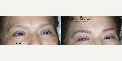 Woman treated with Microblading - Woman treated with Microblading