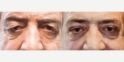 65-74 year old man treated with Upper Blepharoplasty - 48 year old woman treated with Upper Blepharoplasty, correcting droopiness and rejuvenating the overall eye appearance.