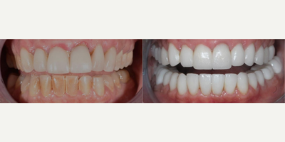 Woman treated with Tooth Repair - Woman treated with Tooth Repair through full mouth reconstruction. Patient had replacement of old crowns and 28 porcelain restorations using veneers as well as fixing of posterior crossbite (notice how the patients upper right side was deficient and had negative space) and masking an overbite.