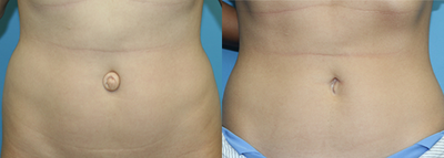 25-34 year old woman treated with Ultherapy - This patient was unhappy with the appearance of her belly button. She had umbilicoplasty.