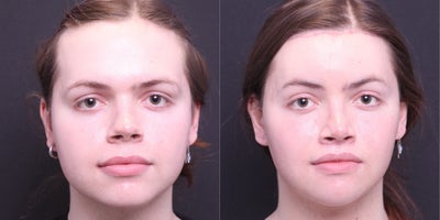 18-24 year old transgender woman treated with Facial Feminization Surgery - Thyroplasty, FGI- face, Browlift, Brow Bone Reduction, Hairline Advancement, Septo/Rhino, Lip lift, Buccal Fat Pad removal, Mandible/Chin Contour , Sliding Genioplasty, Submental Liposuction