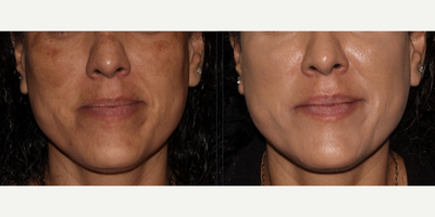 45-54 year old woman treated with SkinPen, Chemical Peel, DiamondGlow - Patient was treated for sun damage and melasma using PRP SkinPen, Chemical peels, and finishing with a DiamondGlow Facial.