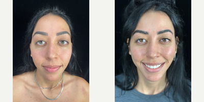25-34 year old woman treated with Canthoplasty - She has a beautiful and unique look before but wanted the outside corners of her lids to tilt more upward and to have less of the white of her eye show. She had a lateral canthoplasty with release of the lower lid retractors to achieve that.