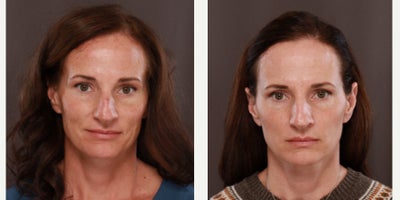 45-54 year old woman treated with Halo Laser, BroadBand Light (BBL) - 1 treatment of Halo and BBL Laser